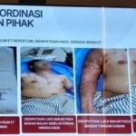RSCM Rilis Kondisi Terkini Aktivis KontraS Andrie Yunus, Disebutkan Terjadi Kekurangan Aliran Darah di Bawah Mata