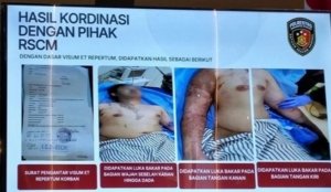 RSCM Rilis Kondisi Terkini Aktivis KontraS Andrie Yunus, Disebutkan Terjadi Kekurangan Aliran Darah di Bawah Mata