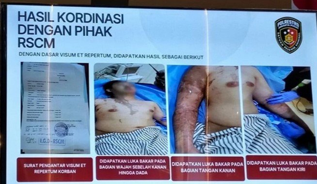 RSCM Rilis Kondisi Terkini Aktivis KontraS Andrie Yunus, Disebutkan Terjadi Kekurangan Aliran Darah di Bawah Mata